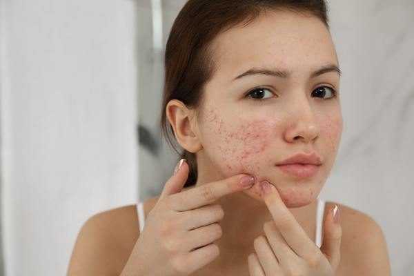 cystic acne